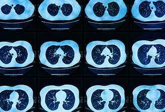 L’IA au service de l’acquisition rapide d’images d’IRM cliniques de gros organes