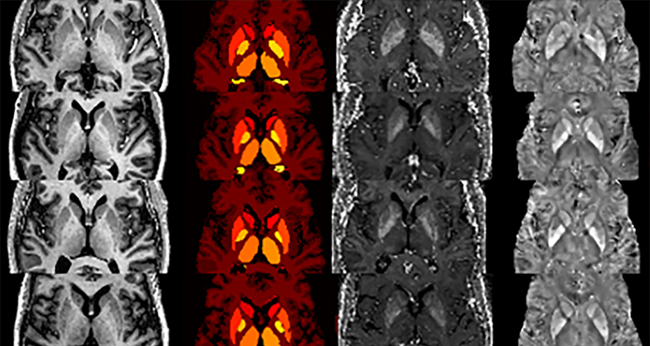 QSM4SENIOR : unprecedented quantitative mapping of the iron load in the central nuclei of the human brain during natural ageing