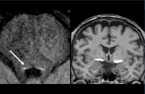 Étude des systèmes neuromodulateurs dans les pathologies Alzheimer et apparentées