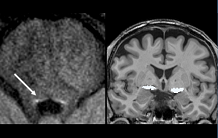 Study of neuromodulatory systems in Alzheimer's disease and related disorders