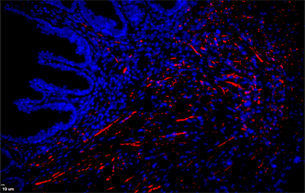 Réseau de nerfs adrénergiques (en rouge) dans des tumeurs à haut risque du cancer de la prostate.