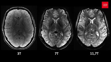 L’IRM Iseult, la plus puissante du monde, permet d’obtenir des images d’une précision inégalée du cerveau humain.